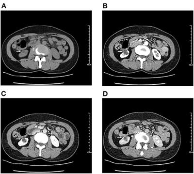 Renal Endometriosis Mimicking Cystic Renal Tumor: Case Report and Literature Review